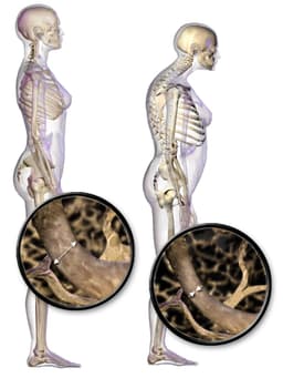 Picture of osteoporosis